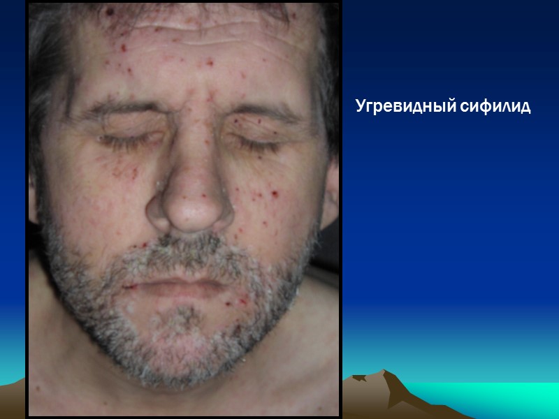 Угревидный сифилид